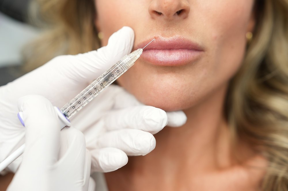Lip Filler